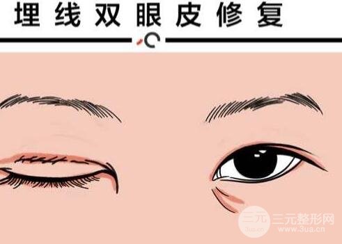 做埋线后老了的危害