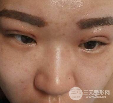做埋线后老了的危害