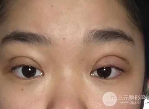 做埋线后老了的危害