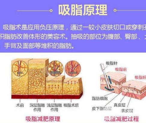水动力吸脂和360环吸的区别