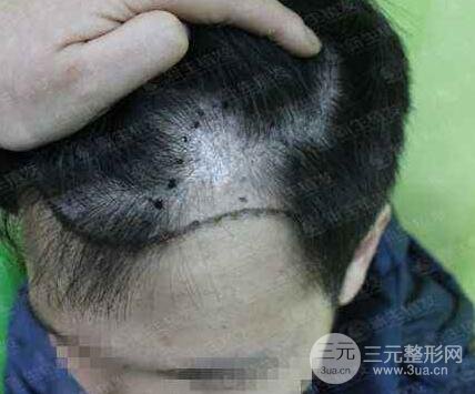 植发十个危害