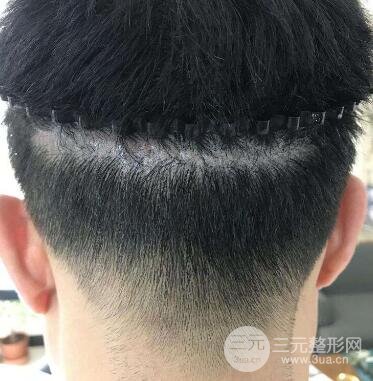植发十个危害