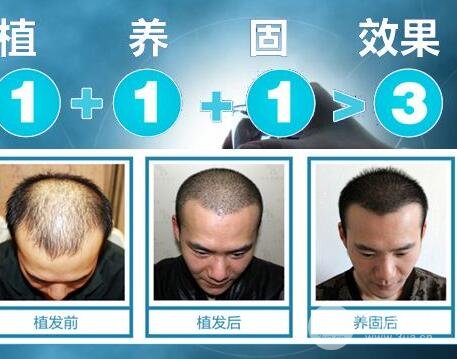 植发十个危害