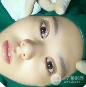 纳米微创和全切哪个好？双眼皮手术区别有哪些？