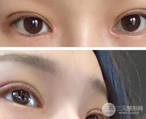 纳米微创和全切哪个好
