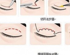 埋线双眼皮过程图解，适合人群有哪些？来涨知识！
