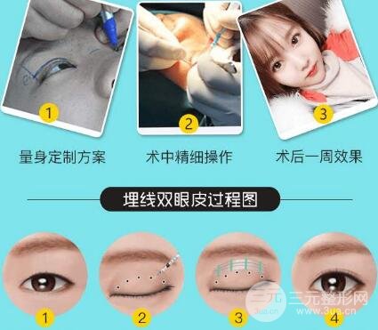 埋线双眼皮过程图解
