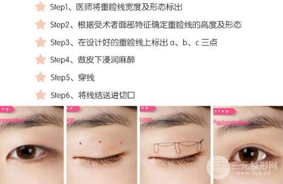 埋线双眼皮过程图解