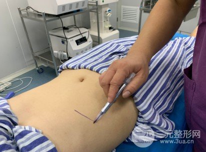共振吸脂减肥果对比