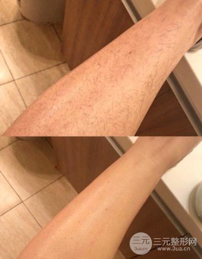 冰点脱毛和激光脱毛的区别