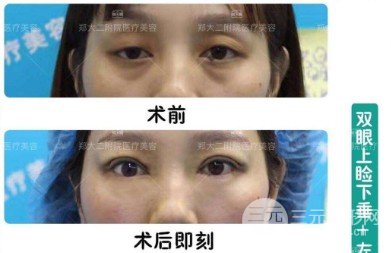 上睑下垂恢复期是多久