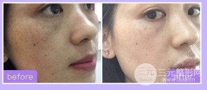 激光祛黄褐斑几次