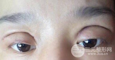 双眼皮失败的八种图片