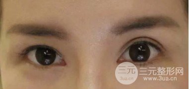 双眼皮失败的八种图片
