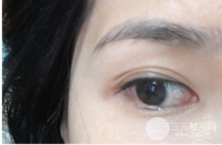 双眼皮失败的八种图片