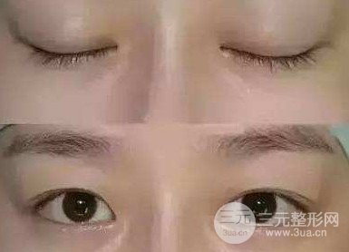 双眼皮失败的八种图片