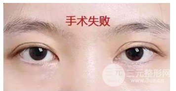 双眼皮失败的八种图片