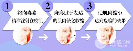 进口注射瘦脸多少钱