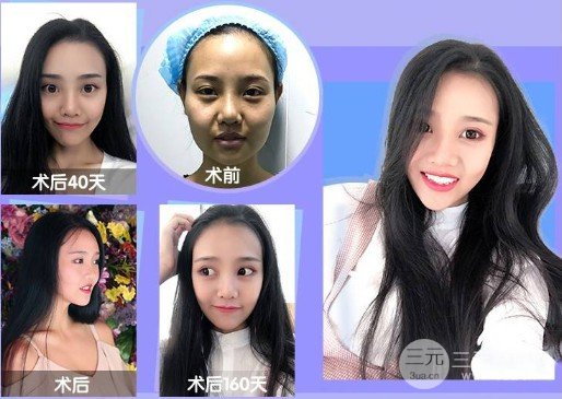 进口注射瘦脸多少钱