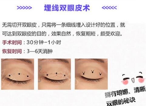 做双眼皮埋线好还是全切好