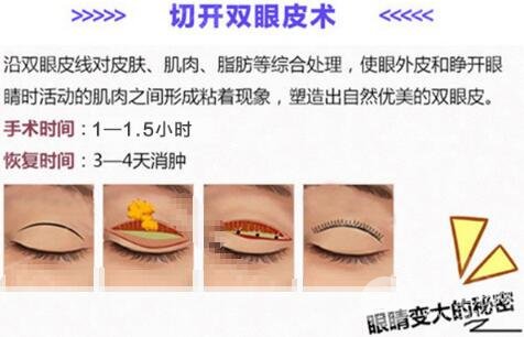 全切双眼皮手术