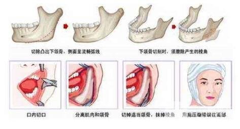下颌角磨骨手术操作流程