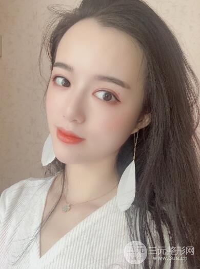 脂肪填充太阳穴恢复期