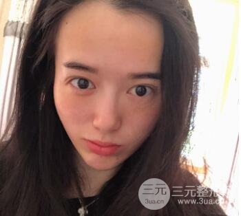 脂肪填充太阳穴手术前
