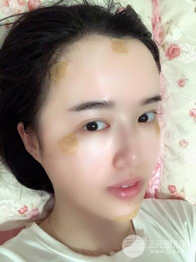 脂肪填充太阳穴手术后