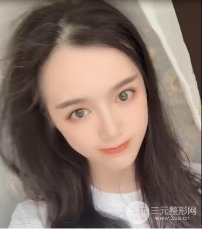 脂肪填充太阳穴恢复期