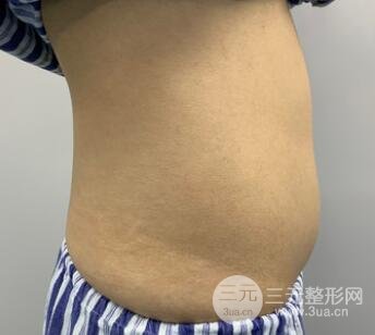 腰腹吸脂手术前
