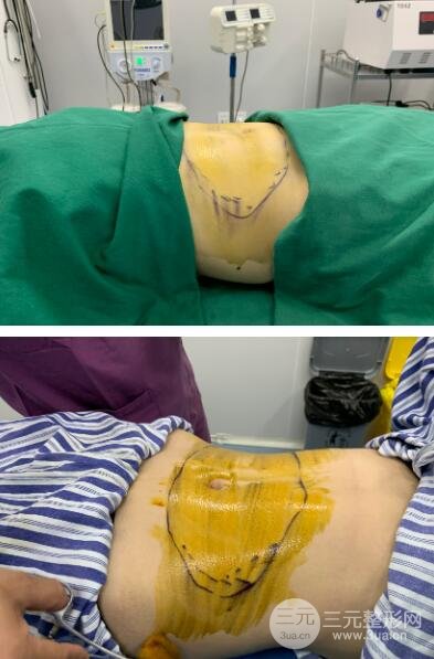 腰腹吸脂手术中