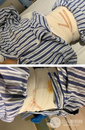 腰腹吸脂手术后