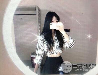 腰腹吸脂手术后