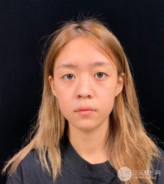 长春中妍整形案例