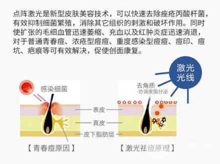 激光缓解痤疮危害