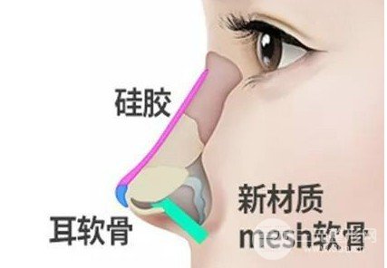人工骨隆鼻弊端