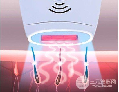 光子嫩肤除毛果怎么样