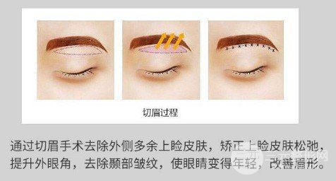 切眉除皱和注射除皱