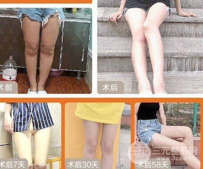 共振吸脂和水动力吸脂