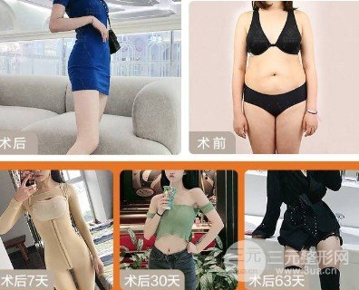 共振吸脂和水动力吸脂