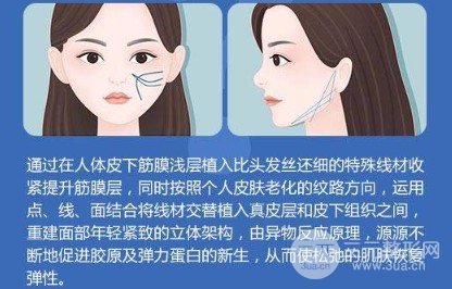 面部轮廓提升针是用什么打的