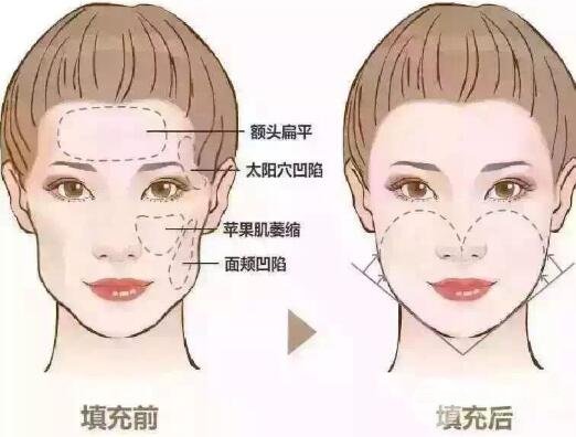 太阳凹陷的人命苦吗