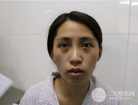 自体脂肪填充太阳穴凹陷案例