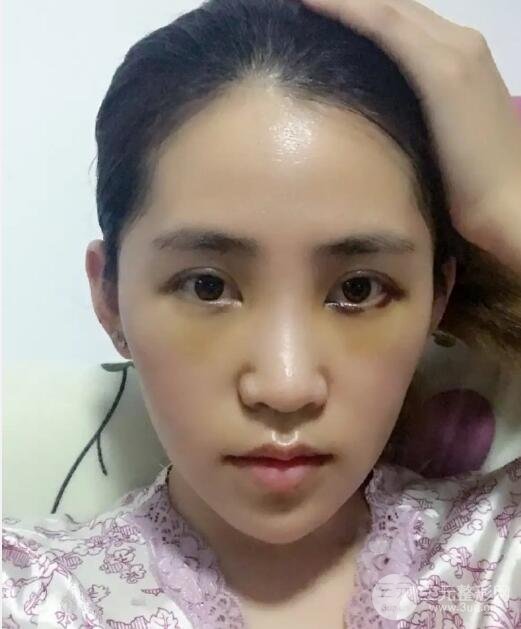 自体脂肪填充太阳穴凹陷案例