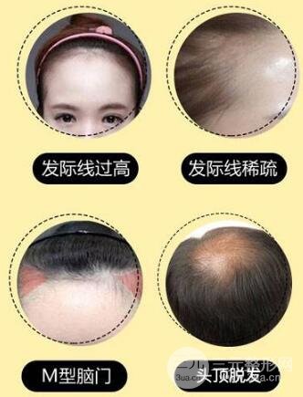 发际线整形价格