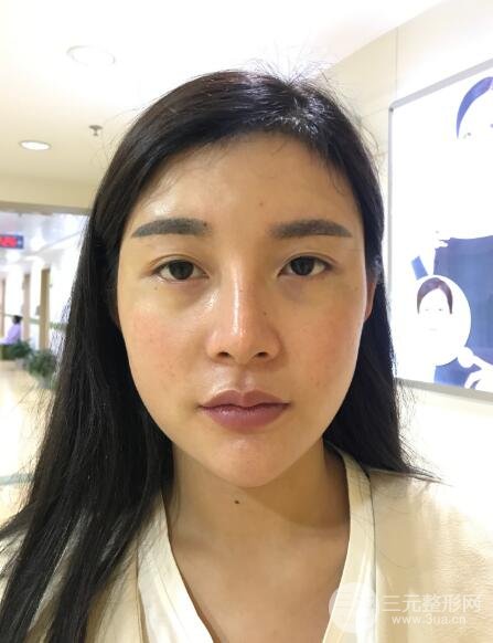 开眼角