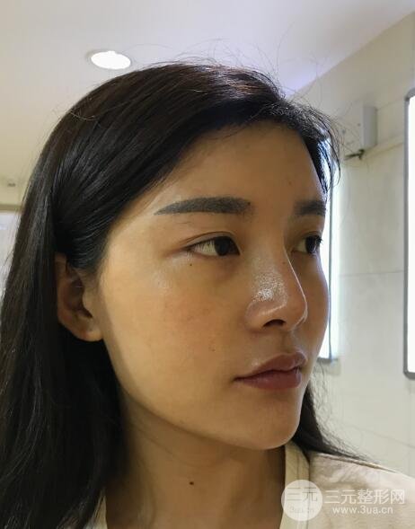 开外眼角手术前