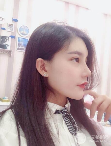 开外眼角手术中