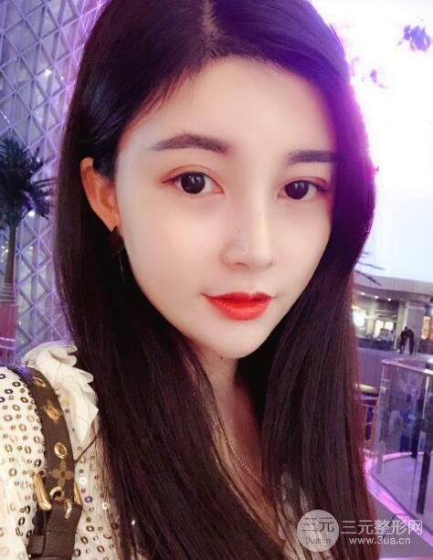 开外眼角手术后